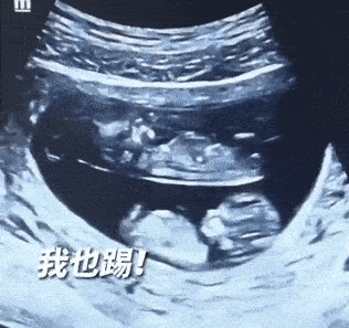2 em bé sinh đôi chia làm 2 tầng trong bụng mẹ gây sốt - Ảnh 1.