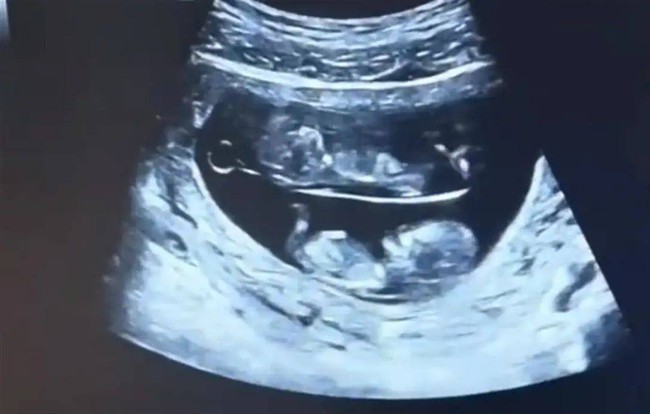 2 em bé sinh đôi chia làm 2 tầng trong bụng mẹ gây sốt - Ảnh 2.
