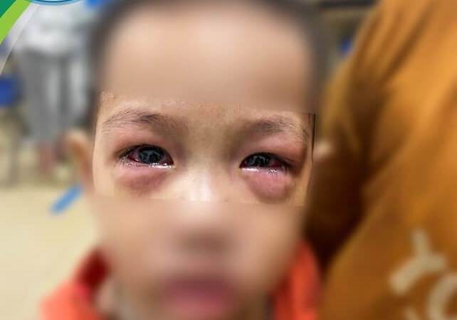 Báo động đau mắt đỏ ở trẻ - Ảnh 1.