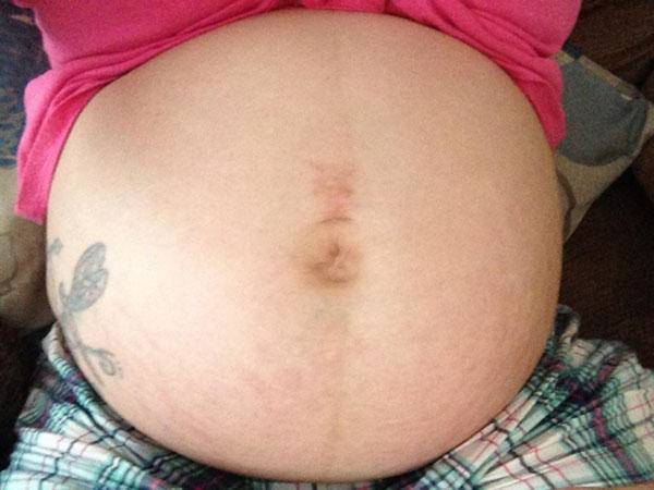 Mẹ bầu thường có đường sọc nâu giữa bụng, ý nghĩa của nó là gì? - Ảnh 2.