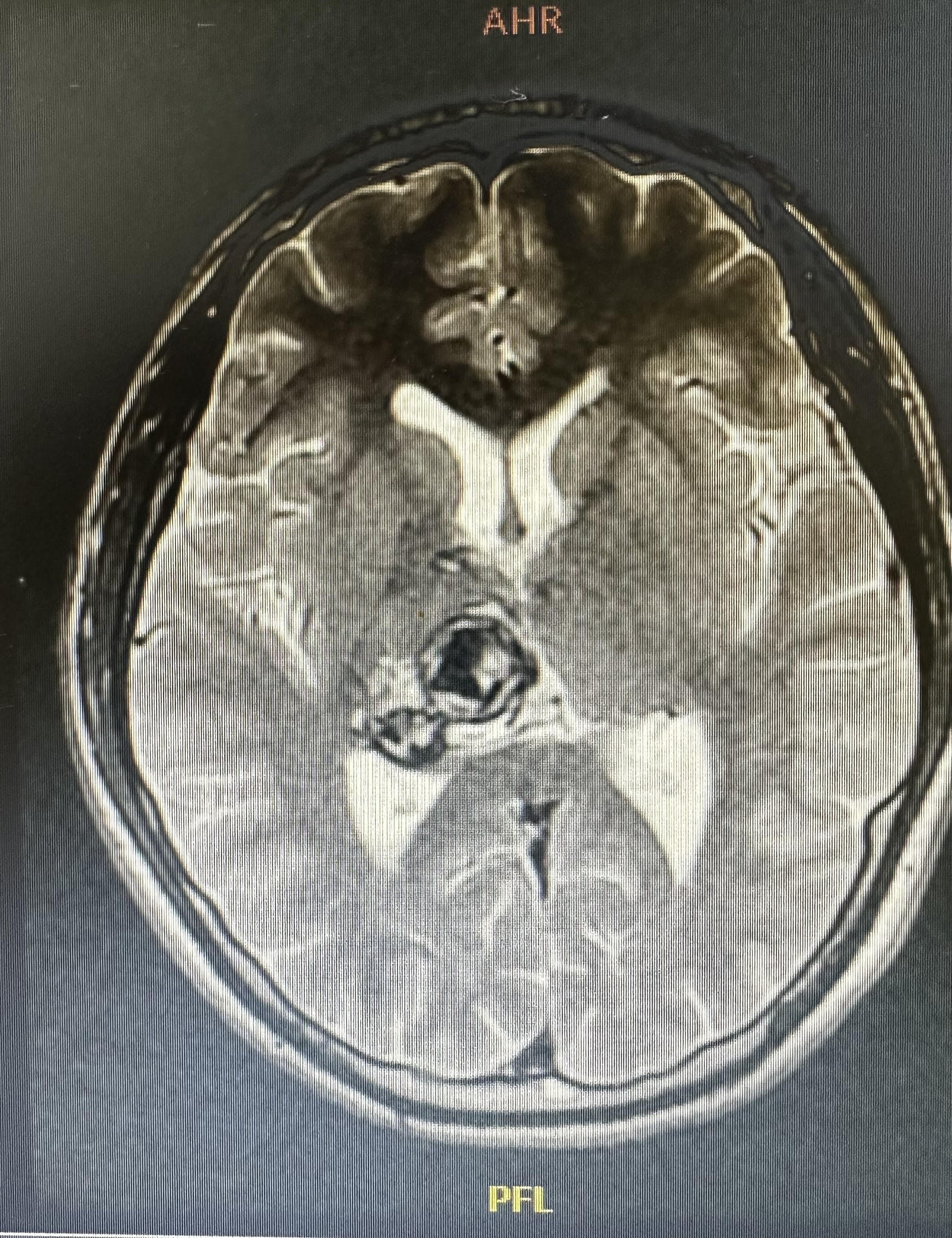 Nam sinh viên 20 tuổi phát hiện khối u não sau khi thấy đau đầu, chóng mặt - Ảnh 1.