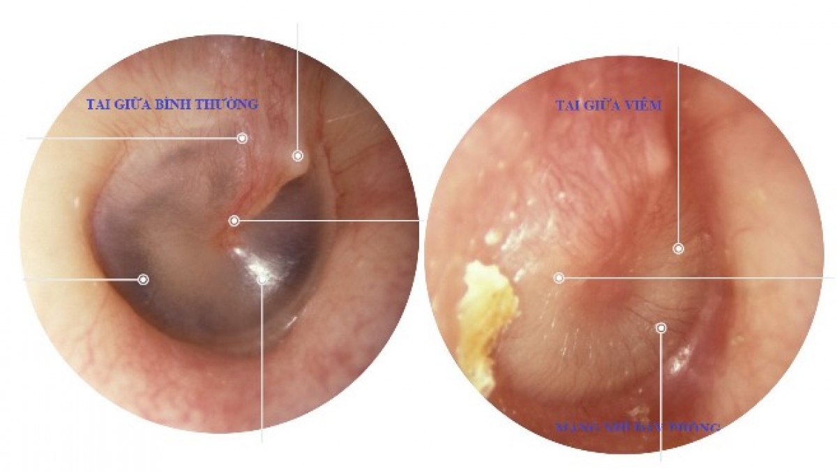 Viêm tai giữa ở trẻ em: Chưa khỏi hay bị tái nhiễm? - Ảnh 2.