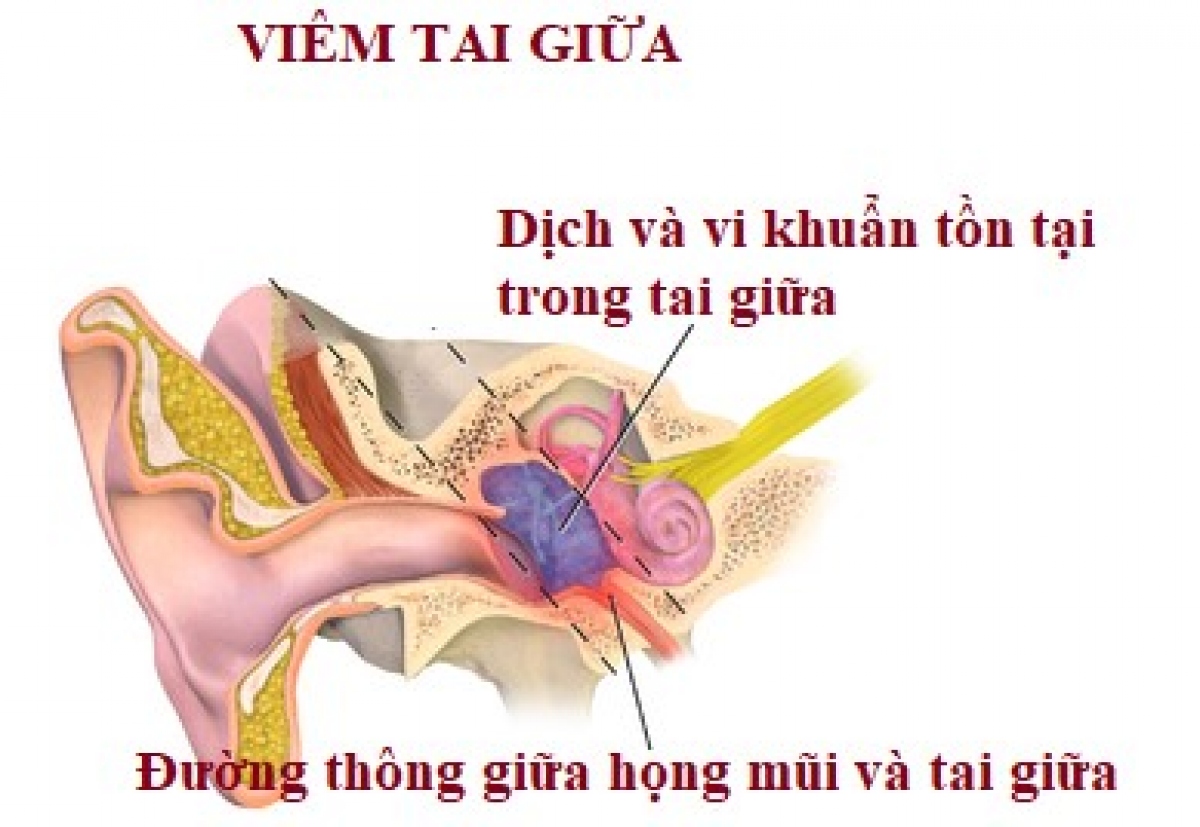 Viêm tai giữa ở trẻ em: Chưa khỏi hay bị tái nhiễm? - Ảnh 1.