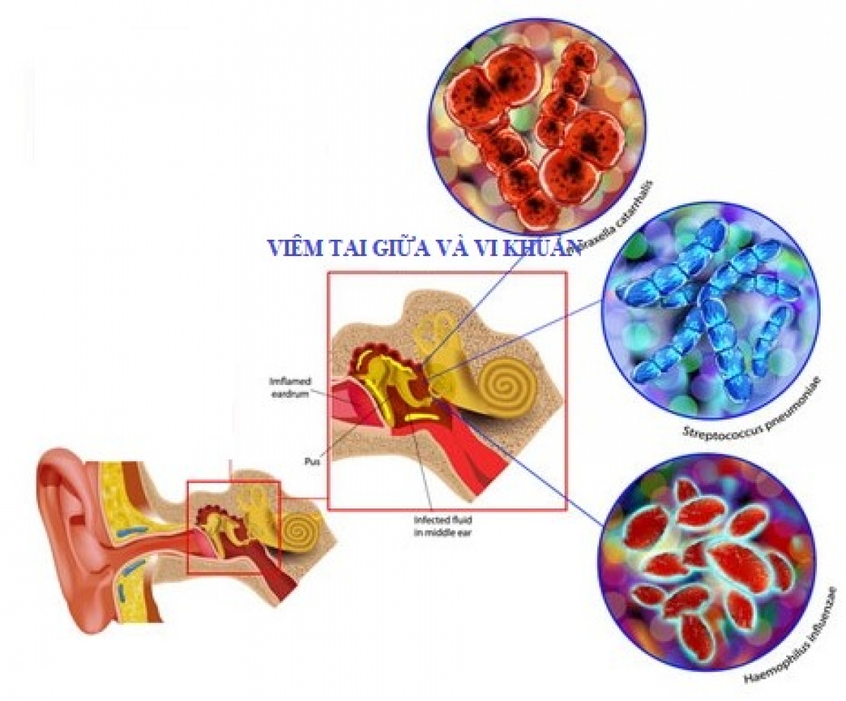 Viêm tai giữa ở trẻ em: Chưa khỏi hay bị tái nhiễm? - Ảnh 3.