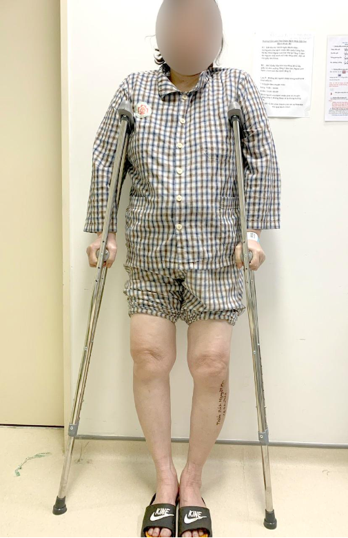 Nguy cơ thay khớp gối ở người bị chân vòng kiềng không được điều trị sớm - Ảnh 1.