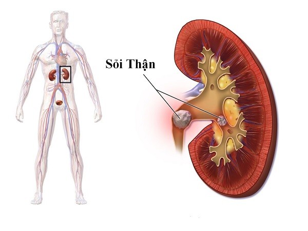 Thói quen tưởng vô hại nhưng lại là nguyên nhân khiến thận chứa cả ‘túi sỏi - Ảnh 2.