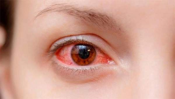 Nhìn người đau mắt đỏ có lây không? 1