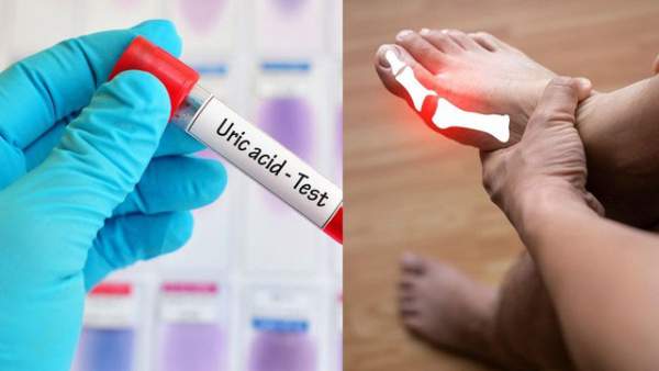 Top 10 cách "đào thải" acid uric một cách tự nhiên, ngừa gout hiệu quả: Nhiều người chưa biết để làm! 1